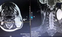 Thiếu nữ Hà Nội vỡ oà niềm vui vì được bác sĩ 'hoá giải' khối u thần kinh 'đeo' 7 năm ở vị trí cực kỳ nguy hiểm