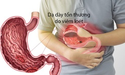 L&#253; do khiến bạn bị cơn đau dạ d&#224;y h&#224;nh hạ