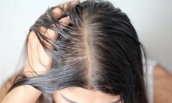 T&#243;c bết da dầu l&#224;m thế n&#224;o khắc phục?