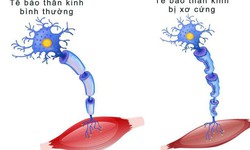 Thuốc điều trị bệnh xơ cột b&#234;n teo cơ