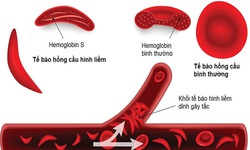 B&#224;i tập tốt cho người mắc bệnh hồng cầu lưỡi liềm