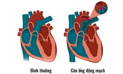 C&#242;n ống động mạch: Nguy&#234;n nh&#226;n, triệu chứng, c&#225;ch ph&#242;ng ngừa v&#224; điều trị