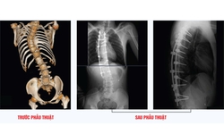 Phẫu thuật chỉnh cột sống h&#236;nh chữ &#39;S&#39; th&#224;nh c&#244;ng cho thanh ni&#234;n 23 tuổi