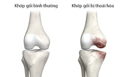 Điều trị bệnh tho&#225;i h&#243;a khớp gối như thế n&#224;o?