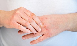 Khắc phục da tay khô trong mùa đông