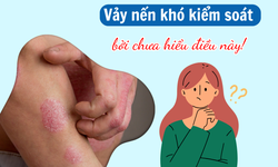 Vảy nến kh&#243; kiểm so&#225;t, dễ t&#225;i ph&#225;t - Hiểu nguy&#234;n nh&#226;n sẽ biết c&#225;ch xử l&#253;