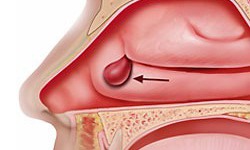 Thuốc v&#224; phương ph&#225;p điều trị polyp mũi