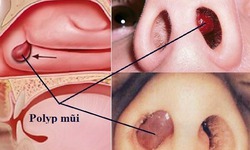 C&#226;u hỏi thường gặp li&#234;n quan đến bệnh polyp mũi