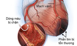 Bệnh mạch v&#224;nh: Nguy&#234;n nh&#226;n, triệu chứng, c&#225;ch điều trị v&#224; ph&#242;ng bệnh