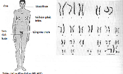 Hội chứng XYY c&#243; chữa được kh&#244;ng?
