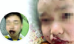 Trẻ bị tổn thương da nặng do dị ứng chậm