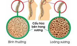 Mối nguy hiểm tiềm ẩn khi phụ nữ thiếu canxi