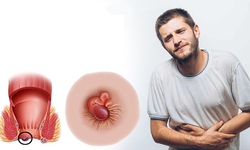 C&#225;c phương ph&#225;p điều trị bệnh trĩ