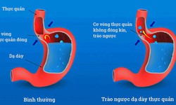 C&#225;c biến chứng nguy hiểm của tr&#224;o ngược dạ d&#224;y thực quản