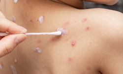 Ghi nhận 1 trường hợp mắc thủy đậu tử vong ở Y&#234;n B&#225;i, cần l&#224;m g&#236; để ph&#225;t hiện sớm biến chứng?