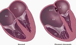 B&#233; 9 ng&#224;y tuổi bỏ b&#250;, t&#237;m t&#225;i cơ thể, b&#225;c sĩ ph&#225;t hiện bệnh nhi dị tật tim bẩm sinh