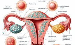 C&#226;u hỏi thường gặp về buồng trứng đa nang