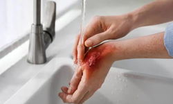 C&#226;u hỏi thường gặp li&#234;n quan đến bỏng