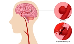 Đau đầu đột ngột coi chừng&#160;ph&#236;nh động mạch n&#227;o