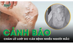 Ch&#226;n nổi mạch m&#225;u, lở lo&#233;t do căn bệnh nguy hiểm nhiều người mắc