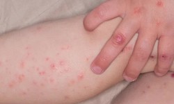 Sở Y tế H&#224; Nội cảnh b&#225;o cao điểm dịch tay ch&#226;n miệng 