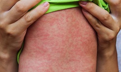 H&#224; Nội ghi nhận ca mắc sởi đầu ti&#234;n trong năm, c&#225;ch ph&#225;t hiện sớm căn bệnh n&#224;y
