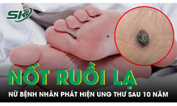 Phát hiện ung thư từ nốt ruồi dưới lòng bàn chân
