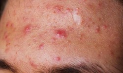 Xử tr&#237; v&#224; ph&#242;ng ngừa dị ứng mỹ phẩm