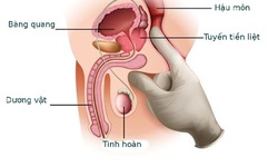 Người cao tuổi mắc u xơ tuyến tiền liệt c&#243; cần phẫu thuật?