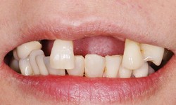 Rụng răng ở người gi&#224; c&#243; ph&#242;ng ngừa được kh&#244;ng?