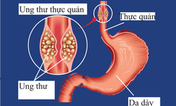 C&#225;c loại thuốc điều trị ung thư thực quản