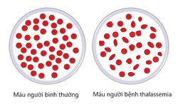 V&#236; sao cần x&#233;t nghiệm gen Thalassemia?