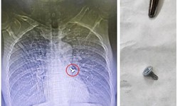 Bất ngờ hắt hơi, người đ&#224;n &#244;ng nuốt lu&#244;n chiếc đinh v&#237;t