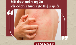 Mề đay mẩn ngứa và cách chữa trị