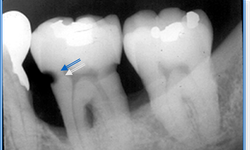 C&#225;c phương ph&#225;p điều trị s&#226;u răng