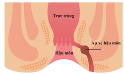 Điều trị &#225;p xe hậu m&#244;n