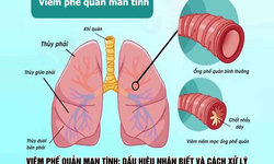 Vi&#234;m phế quản mạn t&#237;nh: Dấu hiệu nhận biết v&#224; c&#225;ch xử l&#253;