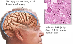 Điều trị bệnh b&#242; đi&#234;n thế n&#224;o?