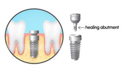 Trồng răng implant c&#244;ng nghệ mới: Tại sao phải sử dụng trụ l&#224;nh thương giải phẫu c&#225; nh&#226;n h&#243;a?