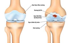 C&#225;c phương ph&#225;p điều trị tho&#225;i h&#243;a khớp gối