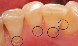 7 biện ph&#225;p loại bỏ cao răng tại nh&#224;