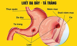 Lo&#233;t dạ d&#224;y t&#225; tr&#224;ng: Nguy&#234;n nh&#226;n, triệu chứng, ph&#242;ng ngừa v&#224; c&#225;ch điều trị