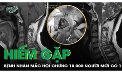 B&#224;ng ho&#224;ng ph&#225;t hiện hội chứng cực hiếm chỉ từ dấu hiệu đau đầu cổ, t&#234; yếu c&#225;nh tay