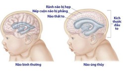 Một số c&#226;u hỏi thường gặp li&#234;n quan đến n&#227;o &#250;ng thủy