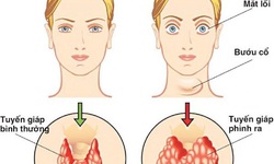 Nguy&#234;n nh&#226;n, triệu chứng của bướu tuyến gi&#225;p v&#224; biện ph&#225;p cải thiện