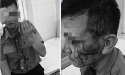 Bảo vệ Bệnh viện K bị ‘c&#242; bệnh viện’ h&#224;nh hung, phải kh&#226;u nhiều mũi