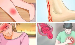 Nhận biết rắn độc và cách sơ cứu khi bị rắn cắn mùa mưa lũ