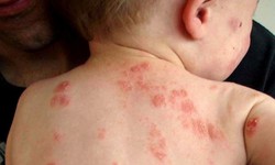 C&#225;c loại ch&#224;m thường gặp v&#224; đối tượng dễ mắc