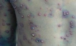 Mắc thủy đậu ở bệnh nh&#226;n đ&#225;i th&#225;o đường sử dụng thuốc v&#224; điều trị thế n&#224;o?