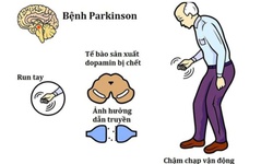 Uống c&#224; ph&#234; c&#243; tốt cho người mắc bệnh Parkinson kh&#244;ng?